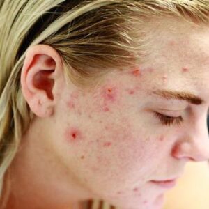 Pimple Skin Care Tips: पिंपल से छुटकारा पाने के लिए अपनाएं ये जबरदस्त घरेलू उपाय