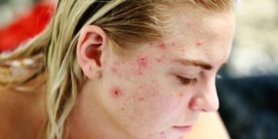 Pimple Skin Care Tips: पिंपल से छुटकारा पाने के लिए अपनाएं ये घरेलू उपाय