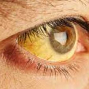 Jaundice Home Remedies: पीलिया को जड़ से ठीक करने के लिए अपनाएं ये घरेलू नुस्खे