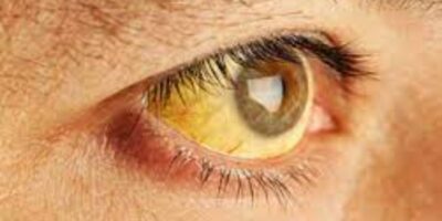 Jaundice Home Remedies: पीलिया को जड़ से ठीक करने के लिए अपनाएं ये घरेलू नुस्खे