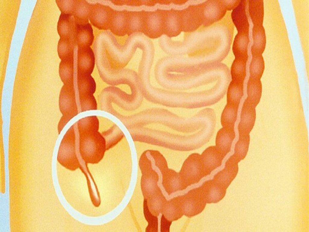 Appendix Symptoms and Causes: अपेंडिक्स होने के मुख्य कारण, लक्षण और इलाज