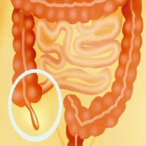 Appendix Symptoms and Causes: अपेंडिक्स होने के मुख्य कारण, लक्षण और इलाज