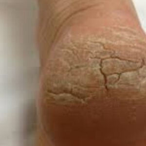 Cracked Heels Remedies: फटी एड़ियों का ऐसे रखें ध्यान, अपनाएं ये घरेलु नुस्खे