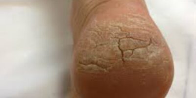 Cracked Heels Remedies: फटी एड़ियों का ऐसे रखें ध्यान, अपनाएं ये घरेलु नुस्खे