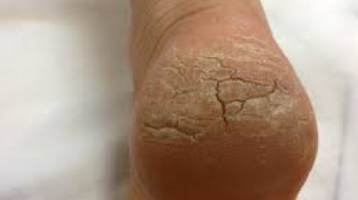 Cracked Heels Remedies: फटी एड़ियों का ऐसे रखें ध्यान, अपनाएं ये घरेलु नुस्खे