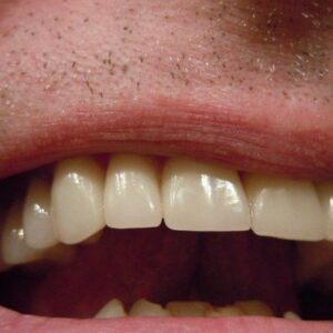 White Teeth Home Remedies: पीले दांतों से छुटकारा पाने के लिए अपनाएं ये घरेलु उपाय