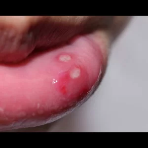 Home remedies for Mouth Ulcers