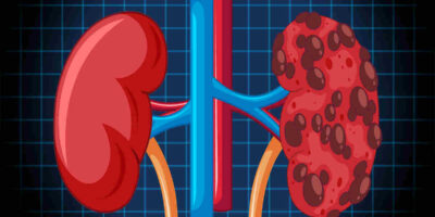 Kidney Failure: किडनी फेल होने से बचना है? इन 5 आदतों को तुरंत बदलें