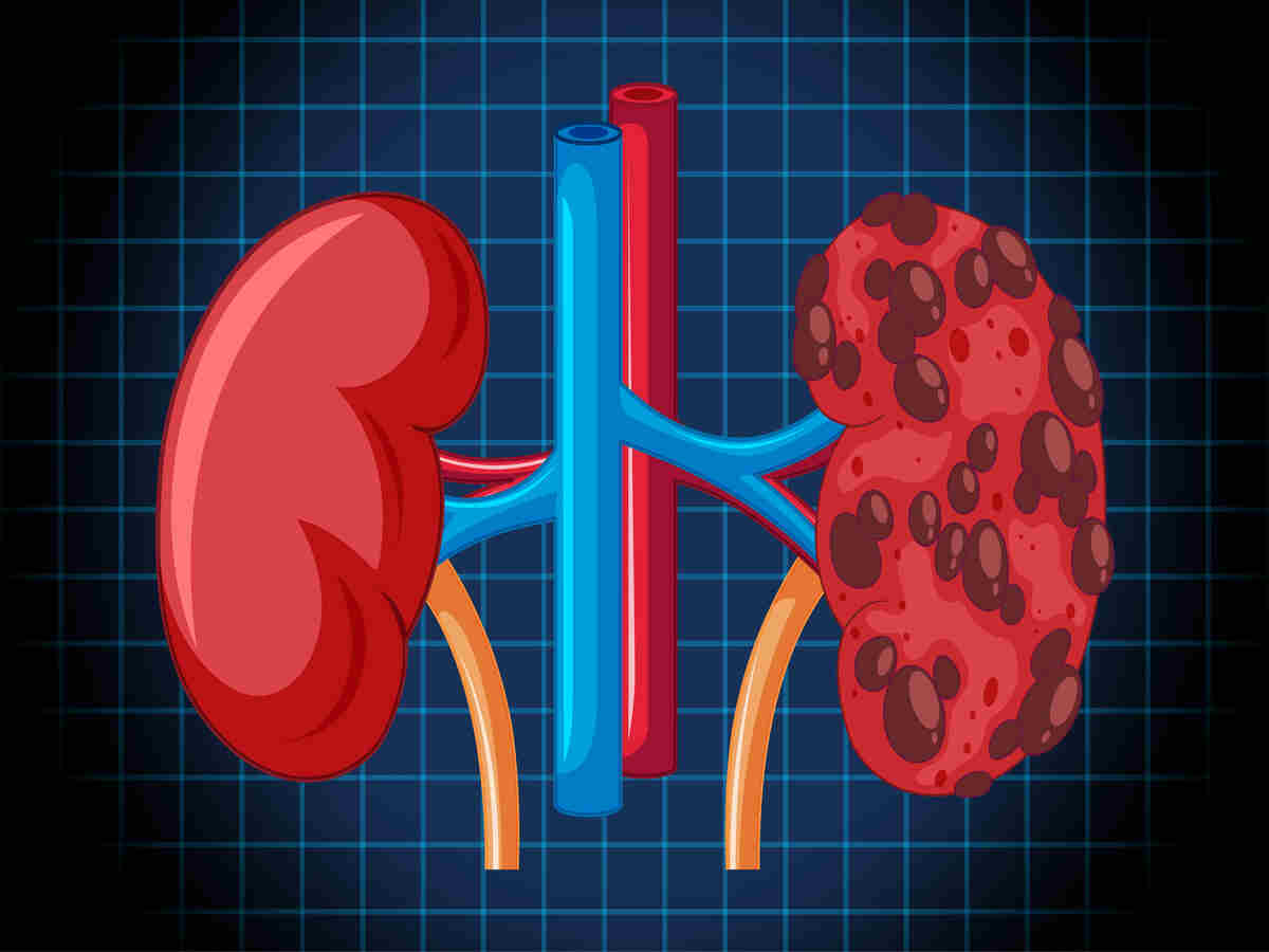 Kidney Failure: किडनी फेल होने से बचना है? इन 5 आदतों को तुरंत बदलें (Image Credit: Freepik)